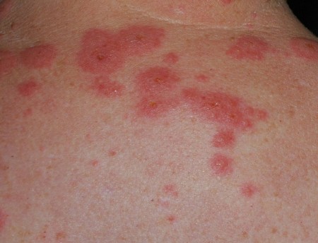 huile de ricin et allergie